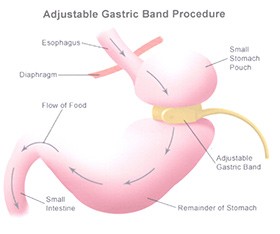 Adjustable Gastric Band procedure